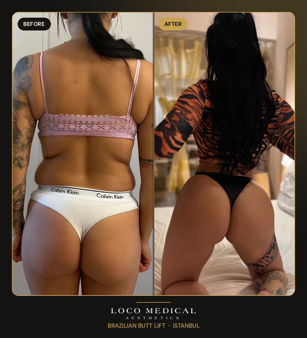 Brazilian Butt Lift before and after — Loco Medical patient 2