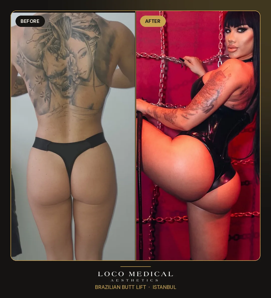 Brazilian Butt Lift before and after — Loco Medical patient 9